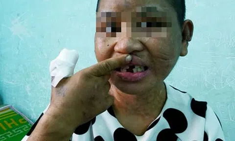 Vụ cô gái bị tra tấn dã man: Bà chủ phủ nhận dùng bàn là, thanh sắt nóng dí lên người